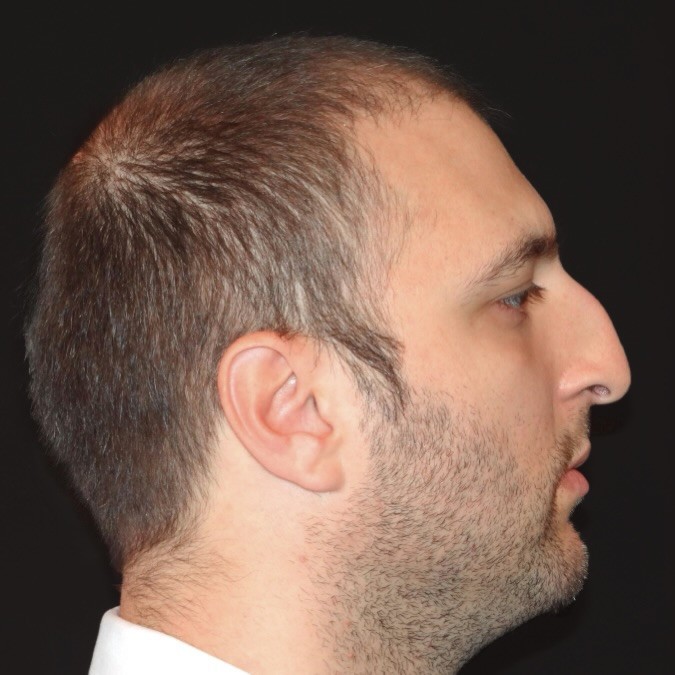 Male Rhinoplasty Before and After Gallery