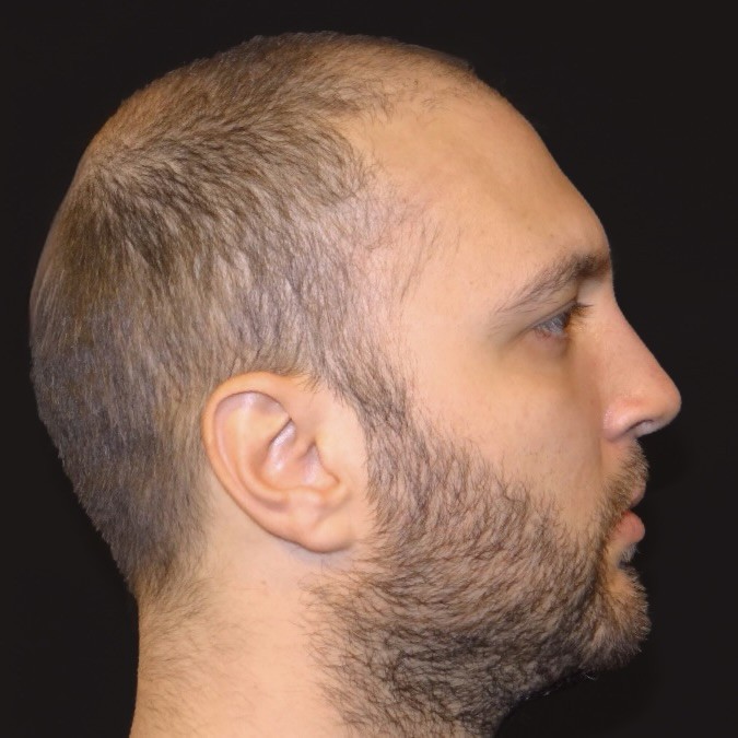Male Rhinoplasty Before and After Gallery