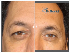 Dr Shahidi blepharoplasty before and after