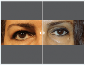 Dr Shahidi blepharoplasty before and after