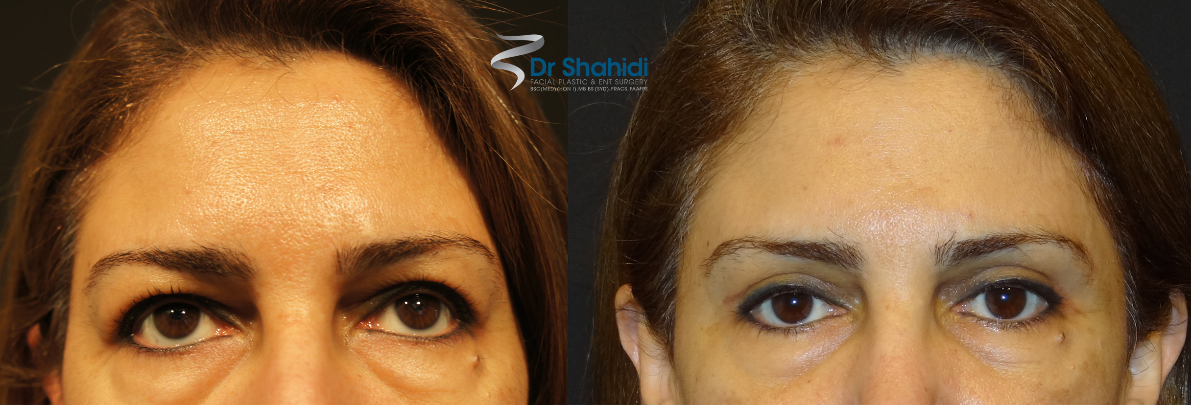 Blepharoplasty Before and After Gallery