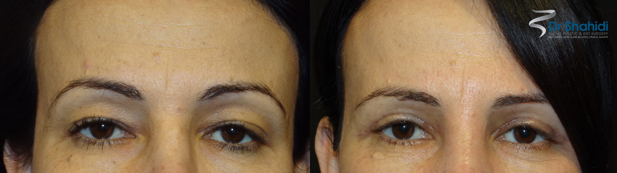 Blepharoplasty Before and After Gallery