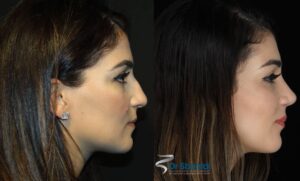 201611182_female_rhinoplasty_before_and_after - 3