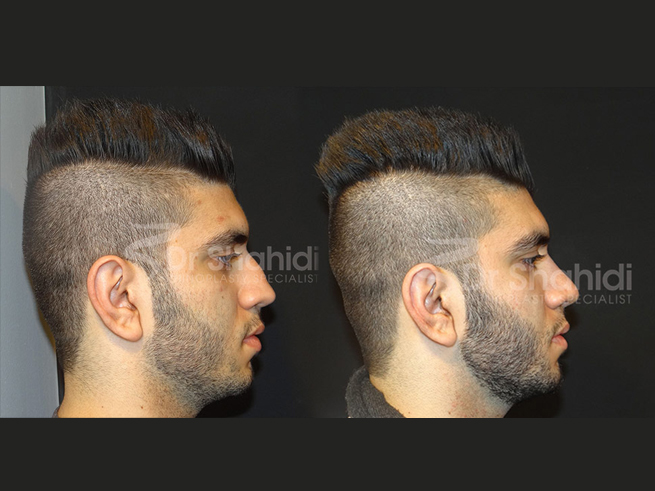 Male Rhinoplasty Before and After Gallery