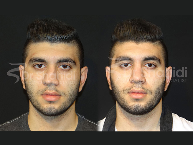 Male Rhinoplasty Before and After Gallery