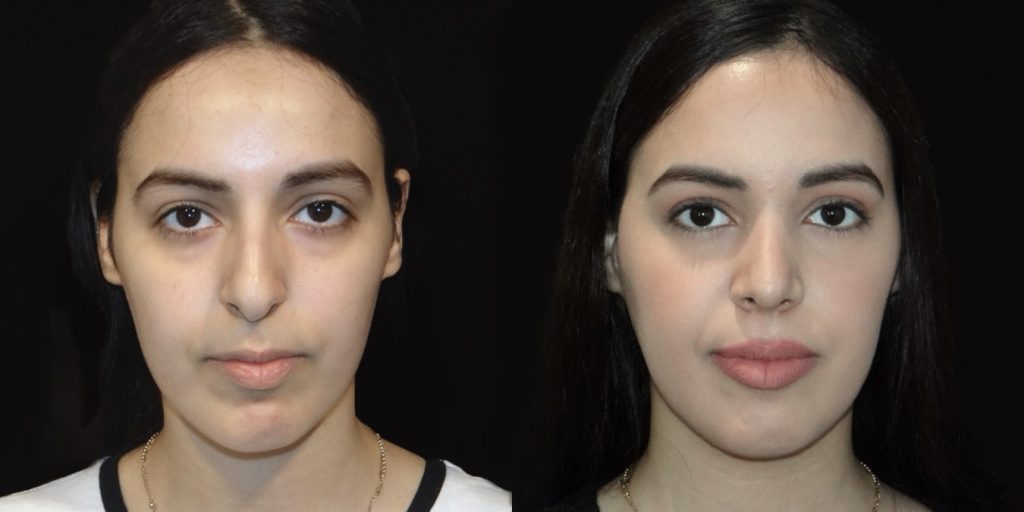 Female Rhinoplasty Before & After Gallery (Female)