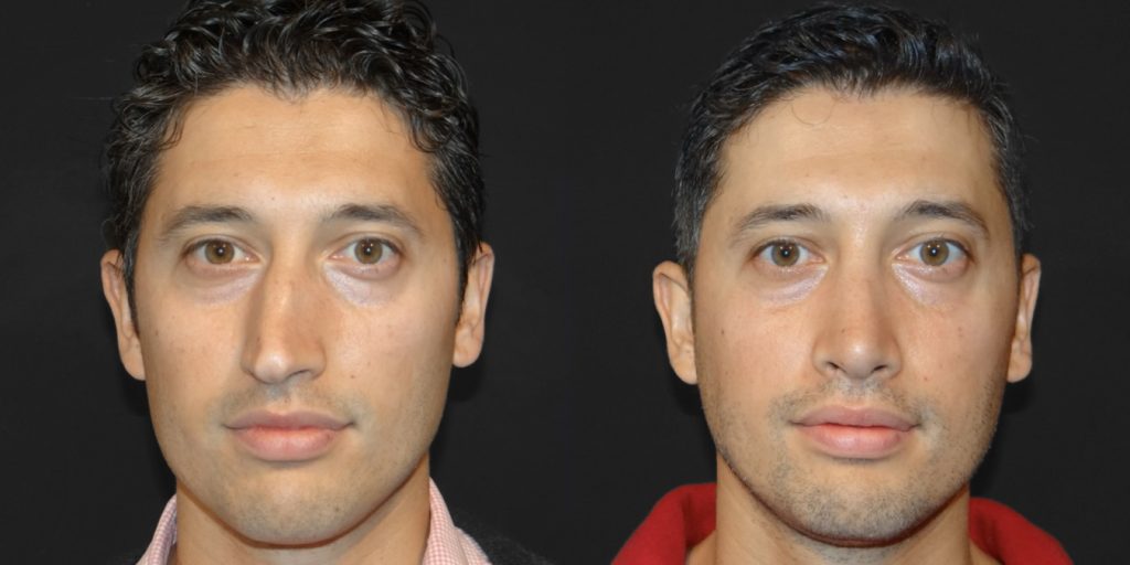 Male Rhinoplasty Before and After Gallery