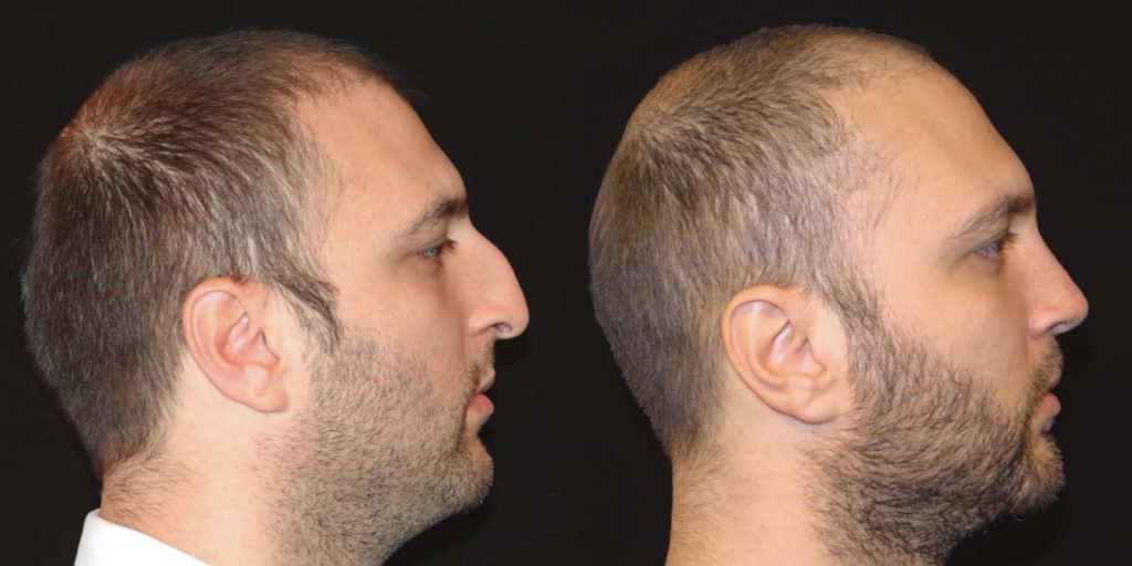 Male Rhinoplasty Before and After Gallery