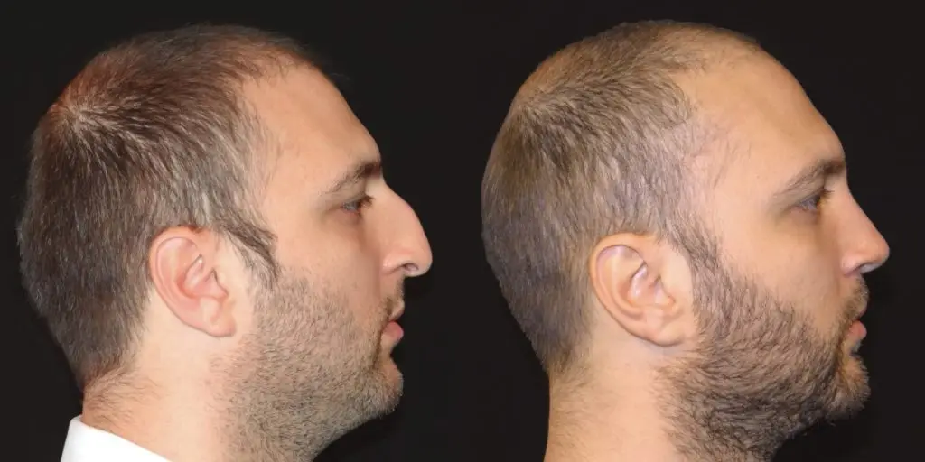 Male Rhinoplasty Before and After Gallery