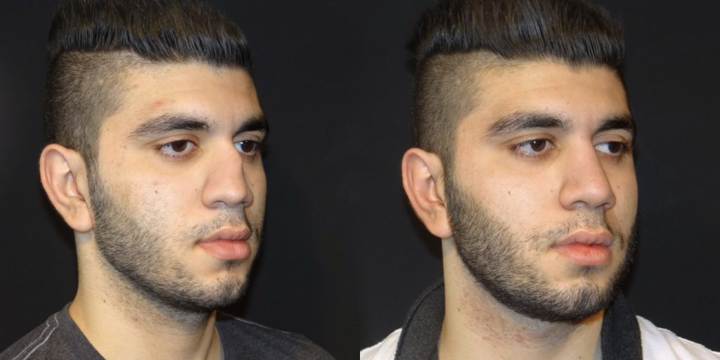 Male Rhinoplasty Before and After Gallery