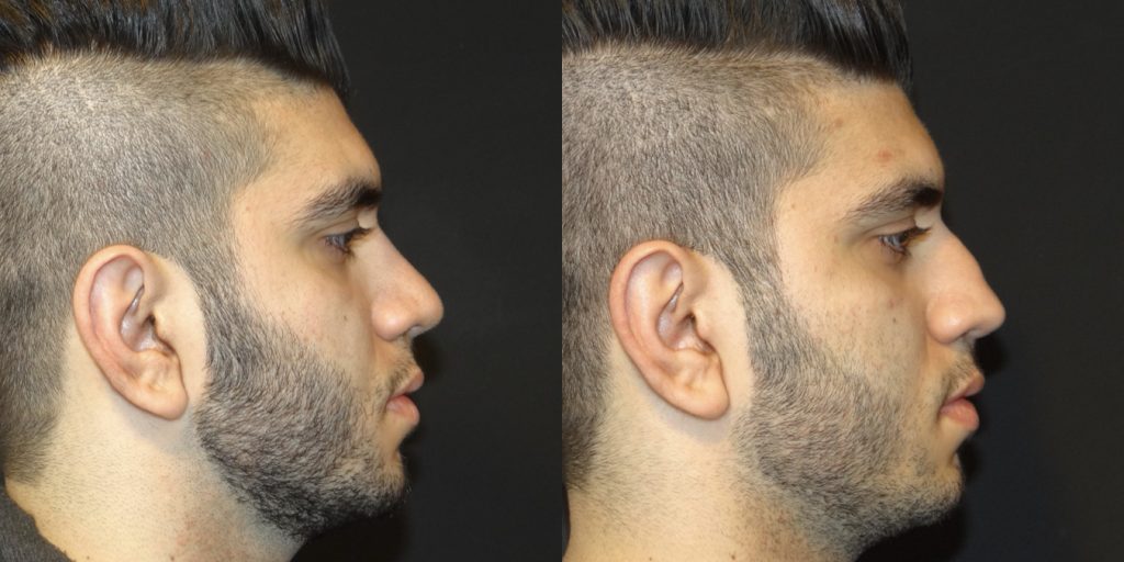 Male Rhinoplasty Before and After Gallery