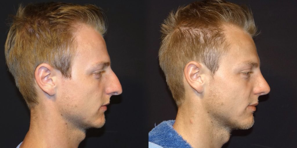 Male Rhinoplasty Before and After Gallery