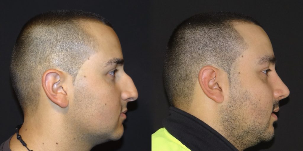 Male Rhinoplasty Before and After Gallery
