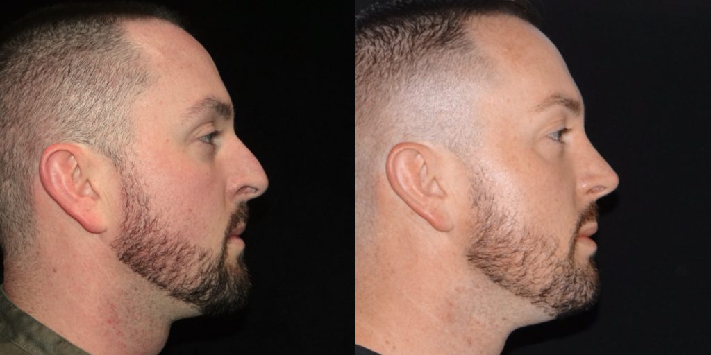 Male Rhinoplasty Before and After Gallery