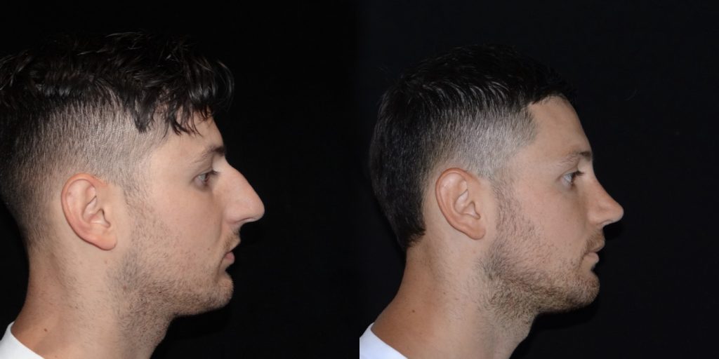 Male Rhinoplasty Before and After Gallery