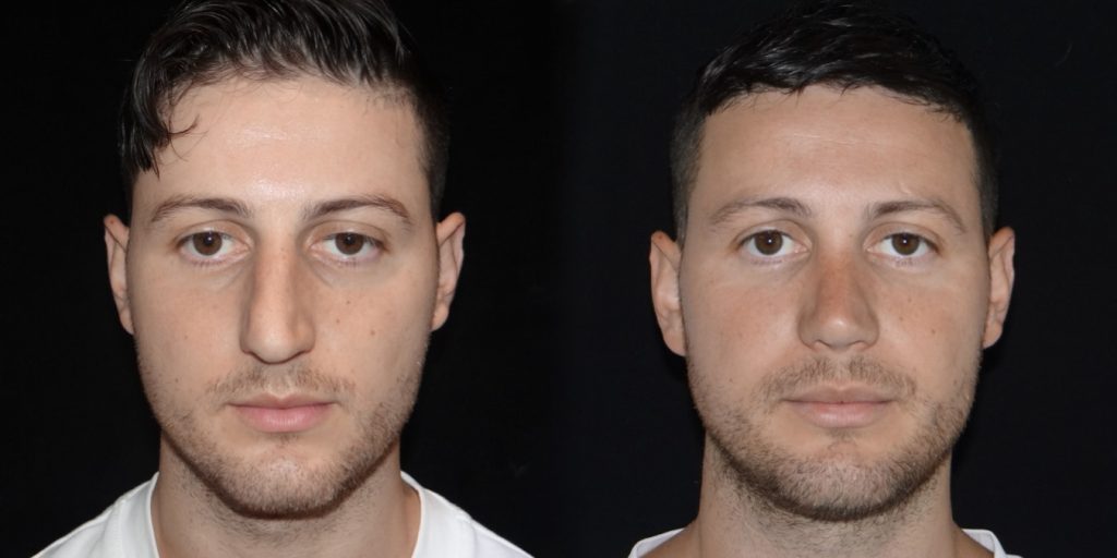 Male Rhinoplasty Before and After Gallery
