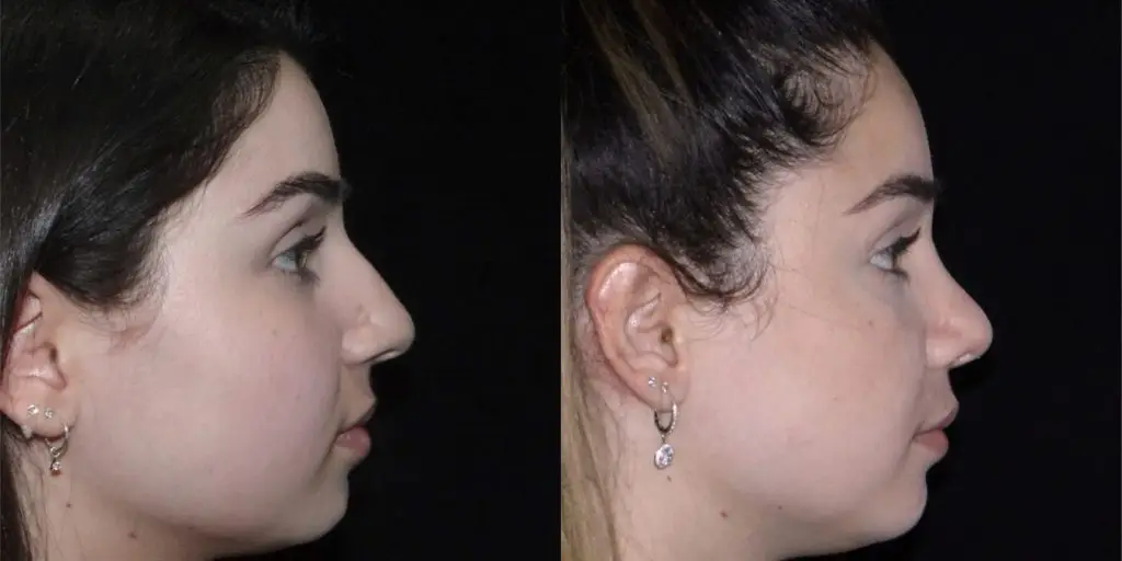 Female Rhinoplasty Before & After Gallery (Female)