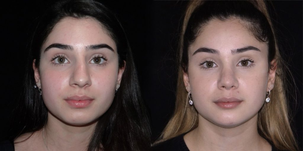 Female Rhinoplasty Before & After Gallery (Female)