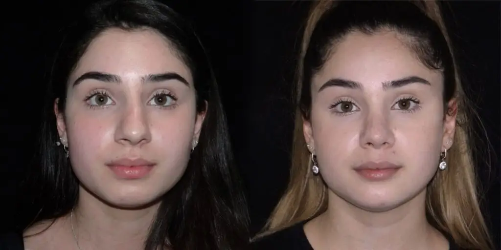 Female Rhinoplasty Before & After Gallery (Female)