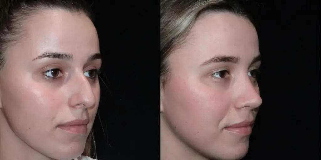 Female Rhinoplasty Before & After Gallery (Female)