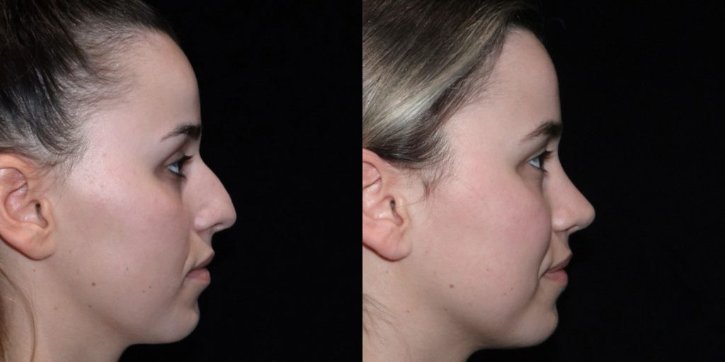Female Rhinoplasty Before & After Gallery (Female)