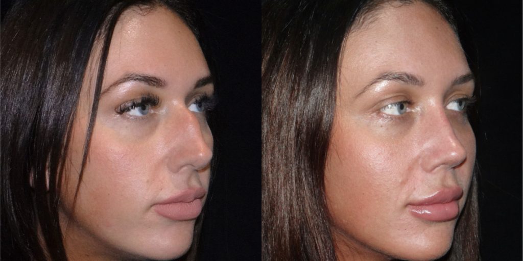 Female Rhinoplasty Before & After Gallery (Female)