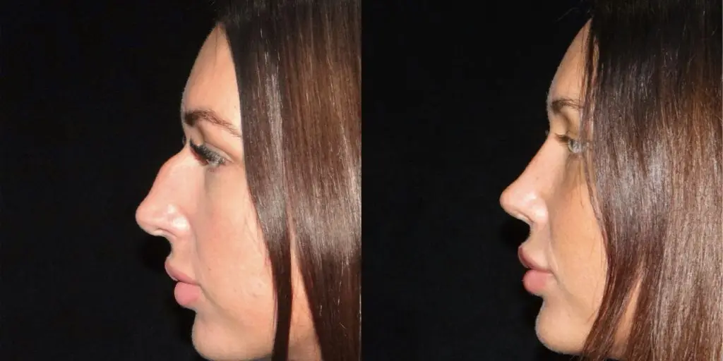 Female Rhinoplasty Before & After Gallery (Female)