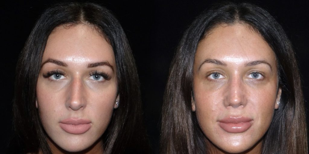 Female Rhinoplasty Before & After Gallery (Female)