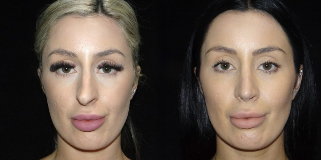 Female Rhinoplasty Before & After Gallery (Female)